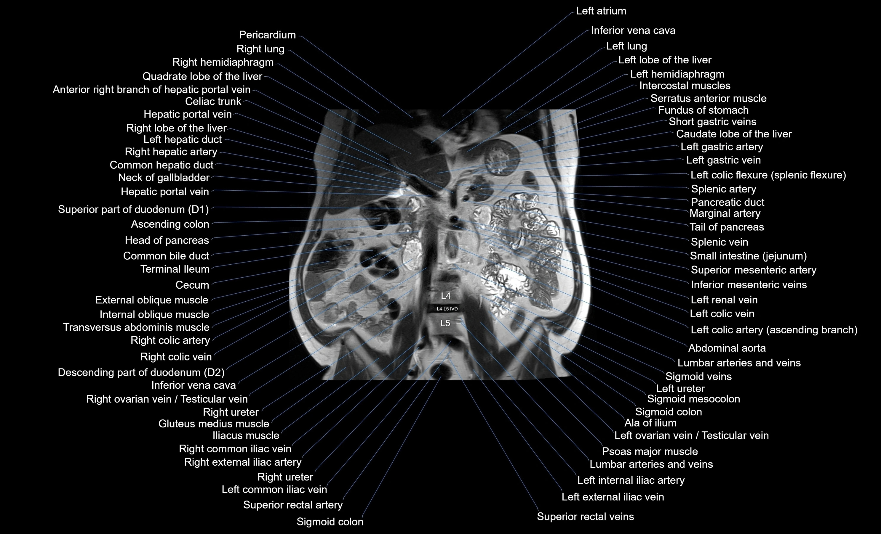 MRI Abdomen coronal labelled cross sectional anatomy radiology  image-img-00001-00030.webp